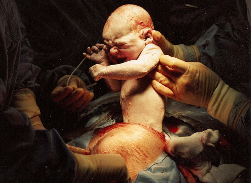 Caesarean birth of the son of Sanet Labuschagne, born Greeff.